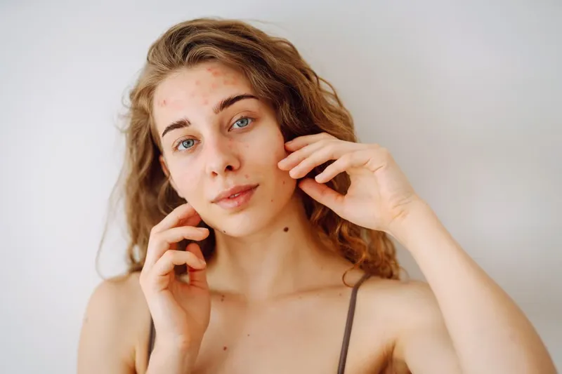 Close-up of skin with acne